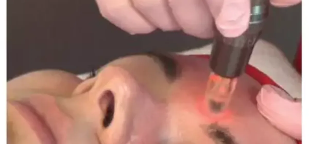 Zabieg Dermapenem w okolicy oka